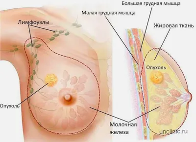 Рак груди операция, органосохраняющая и радикальная операция при раке молочной  железы