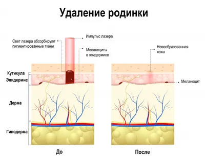 Преимущества лазерного удаления родинок