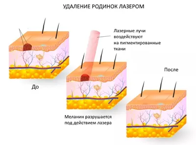 Удаление родинок лазером в Санкт-Петербурге | Клиника \"Отражение\"