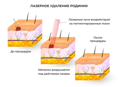 После удаления бородавки клиника доктора Шестакова Ю. И.