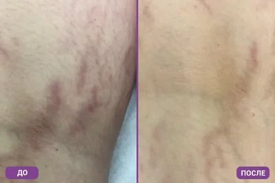 Лечение рубцов лазером в Тюмени, удаление шрамов после удаление родинок |  Авторская клиника