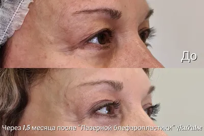 Лазерная коррекция рубцов и шрамов - клиника лазерной косметологии в Москве