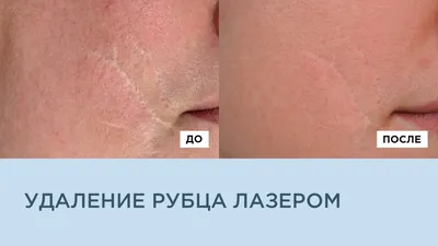 ᐅ Лазерное удаление шрамов в Киеве ᐊ Цены и отзывы на шлифовку шрама лазером  в клинике Аура