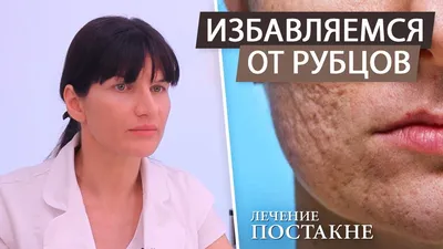 Как удалить шрамы и рубцы на лице после акне (постакне). Лазерная шлифовка  после угрей и прыщей - YouTube