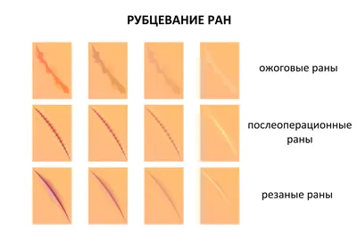 Удаление шрамов и рубцов на руках, ногах, теле, спине, груди: сколько стоит  удаление в клинике СПб