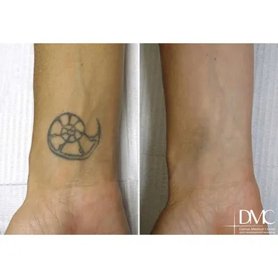 Лазерное удаление татуировок — ФОТО до и после - LINLINE