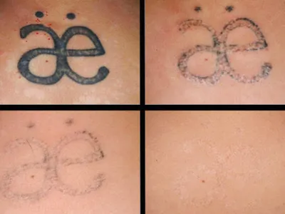 Удаление татуировки — как выглядит кожа после процедуры, о чем стоит знать  / AdMe