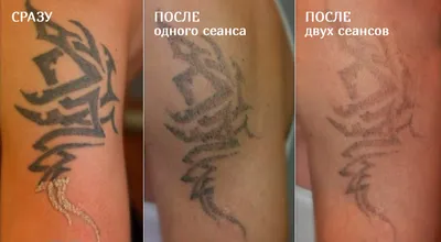 Удаление татуировок на пикосекундном лазере (Picoway) в Москве по цене от  9500 руб. в клинике Beauty Trend