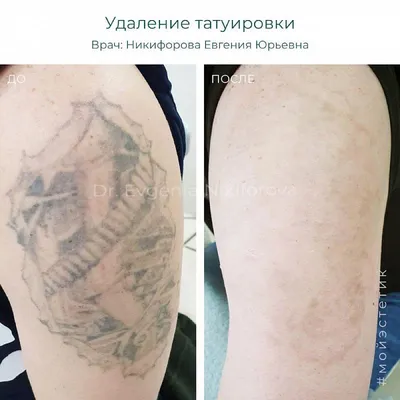 Удаление татуировок