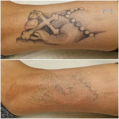 Удаление татуировок и татуажа: методы, особенности, описание процедуры -  Клиника \"Отражение\"