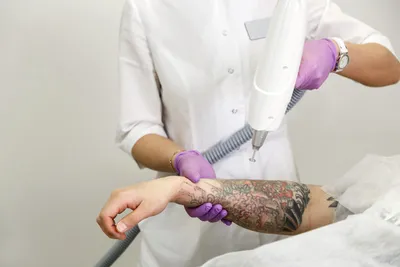 Удаление тату и выведение татуировок. Все способы | Блог о тату
