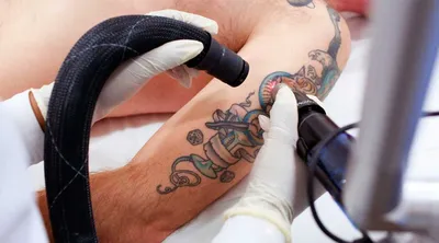 Можно ли убрать татуировку полностью - Tattoobrand.ru