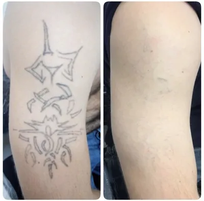 Удаление тату по низким ценам - лазерное удаление татуировки в Москве