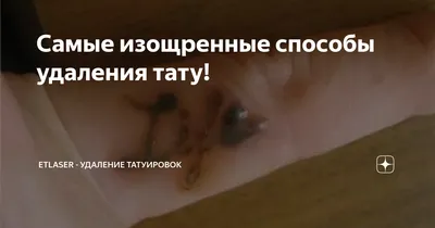 Удаление Тату на пальцах в Киеве | RedRay Studio