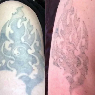 Как удалить татуаж бровей в домашних условиях быстро? Как вывести татуаж?  Аня Дубовик - YouTube
