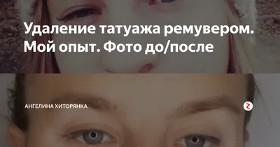 Удаление татуажа ремувером \"Tattoo Оff\" - 🍃 Удаление старого татуажа губ  татуремувером \"TATTOO OFF\". На фото сразу после первой процедуры удаления  старого татуажа ремувером \"TATTOO OFF\" Работа представителя: Раисы  Лебедевой 📄 \"TATTOO