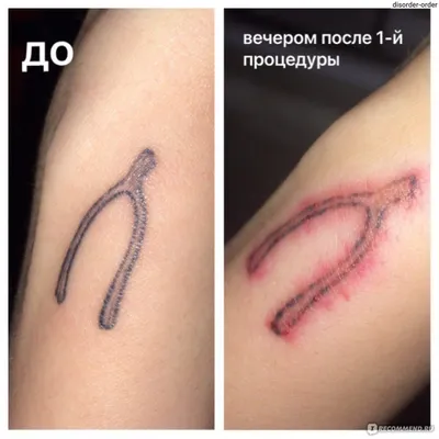 Лазерное удаление тату/татуаж Челябинск (@olga_lazer74) • Instagram photos  and videos