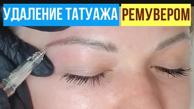 Удаление татуажа ремувером в Днепре: цены, фото-результаты выведение Beauty  look