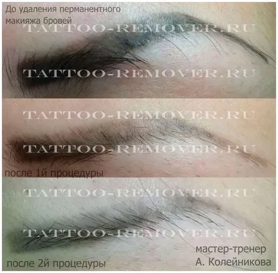 Kate Baranova - Удаление татуажа препаратом #revivink ✓ Хорошо видит  \"сложные \" для лазера цвета, такие как белый, бежевый , зелёный , жёлтый,  голубой. Оптимальное, щадящее решение для удаления татуажа век👁 Отлично