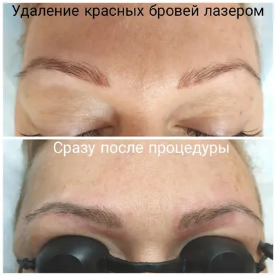 Удаление татуажа пикосекундным лазером Picosure — VIP Clinic в Москве. Удаление  татуажа бровей, губ, перманентного макияжа на веке лазером Picosure. Цены,  отзывы