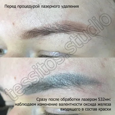 Удаление татуажа пикосекундным лазером Picosure — VIP Clinic в Москве. Удаление  татуажа бровей, губ, перманентного макияжа на веке лазером Picosure. Цены,  отзывы