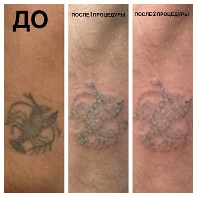 Удаление татуажа лазером в Екатеринбурге: 61 мастер по удалению тату со  средним рейтингом 5.0 с отзывами и ценами на Яндекс Услугах.