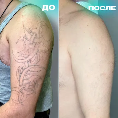 Удаление татуировок лазером в Алматы. Цены и отзывы.