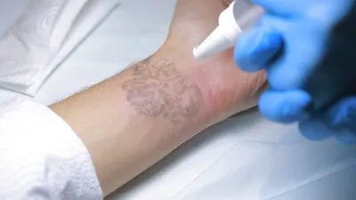 Лазерное удаление татуажа, обучение и оборудование. | Sokolov Laser - Удаление  тату | Дзен