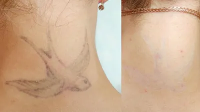 Удаление татуажа и татуировок | Студия эпиляции и косметологии