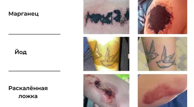 Альтернативные способы удаления татуировок | Блог о тату