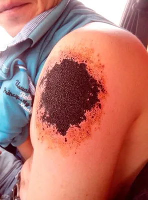 Киев Удаление тату татуажа лазером Результаты Фото Отзывы