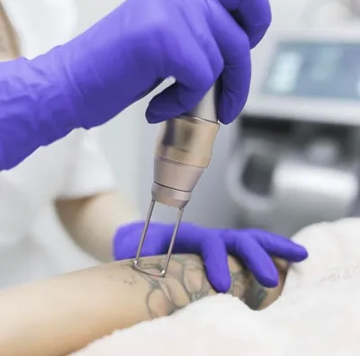 Опасная метка. Как сведение татуировки может убить организм
