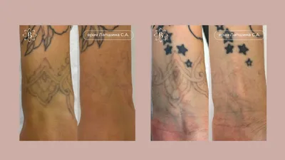 Удаление татуажа лазером фото до и после фото