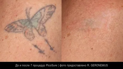 Что важно знать о лазерном удалении татуажа бровей - новости Бурятии и  Улан-Удэ