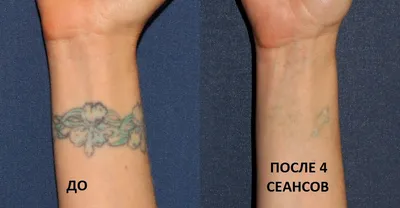 Лазерное удаление некачественного татуажа | MODERN MAKEUP