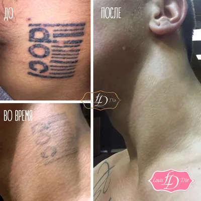 Et.laser Удаление тату и татуажа в Москве - На фото после - «Фрост» -  абсолютно безопасное и регулярное явление на 😎процедурах удаления  татуировок. Это знак, который дает знать специалисту, что попадание в