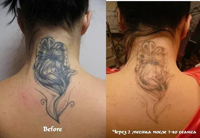 Лазерное удаление тату и татуажа во Львове - клиника Mediostar