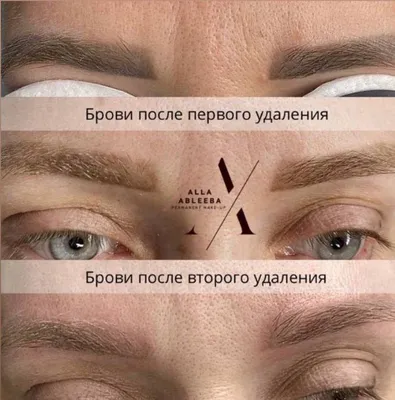 Удаление некачественного перманентного макияжа лазером и ремувером в  Санкт-Петербурге.
