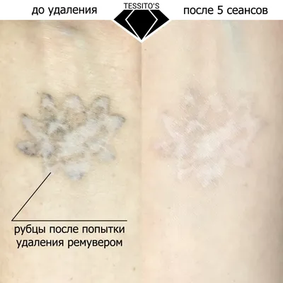 Удаление татуажа ремувером: отличия от лазерного удаления | Kramer PMU  Studio