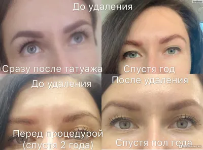 Permanent MakeUp Croatia - Удаление татуажа ремувером. После удаления  лазером нежелательного татуажа могут остаться зеленый и белый цвет, после  чего лазер бессилен. Лазерный луч не видит зеленый (оксид хрома) и белый  (диоксид