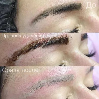 BROW LASH Studio - УДАЛЕНИЕ ТАТУАЖА РЕМУВЕРОМ На фото виден результат после  1й процедуры удаления ремувером 🔹CRC (США)🔹 . Сверху брови до процедуры -  татуажу 8 лет Снизу брови - через 1,5