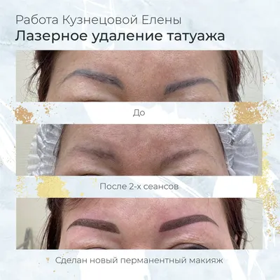 Удаление татуировок пикосекундным лазером Picosure - Vip Clinic.  Пикосекундный лазер удаление тату в Москве. Доступные цены