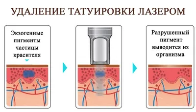 Удаление тату лазером в СПб / Свести татуировку - цены, запись