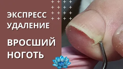 Лечение вросшего ногтя