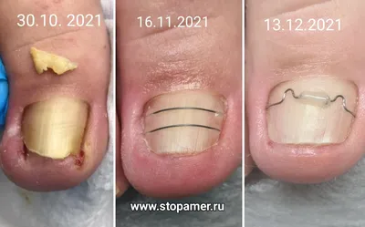 ⭐ Как лечить вросший ноготь? - Безболезненное удаление - podonails.com