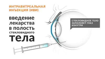 Озурдекс - интравитреальные уколы в глаз, цена процедуры в Москве