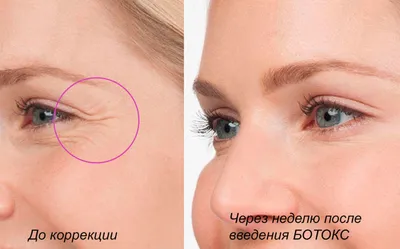 Ботокс от морщин вокруг глаз (\"гусиные лапки\") | Цены в Нижнем Новгороде