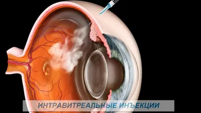 Уколы в глаз в Санкт-Петербурге, стоимость интравитреальных инъекций