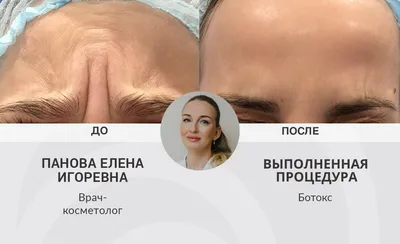 Уколы Ботокса (Botox)