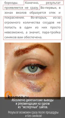 Мезотерапия под глаза: мезо вокруг глаз в салоне Kika-Style, Киев